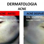 Acné